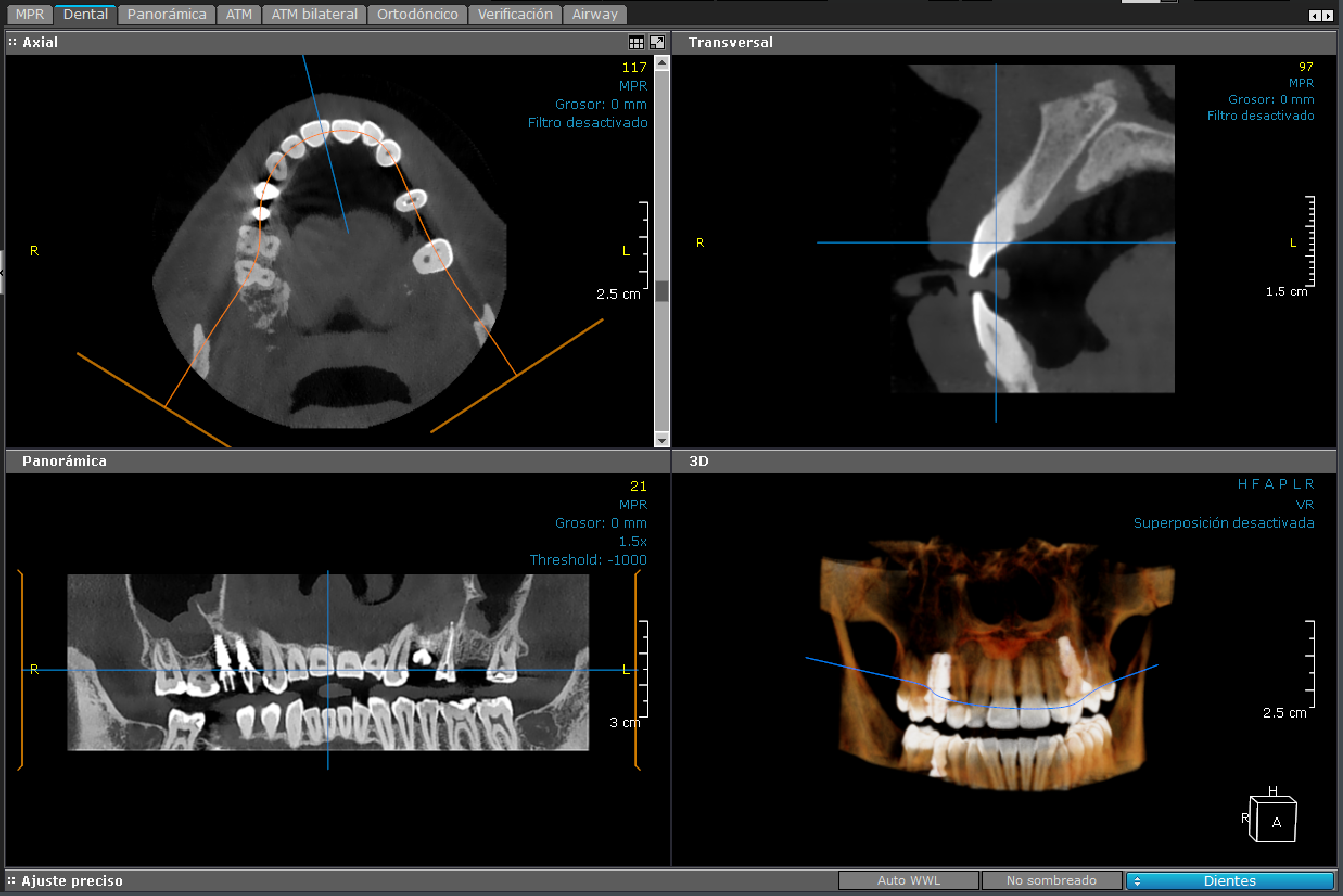 3D - Maxilar Superior