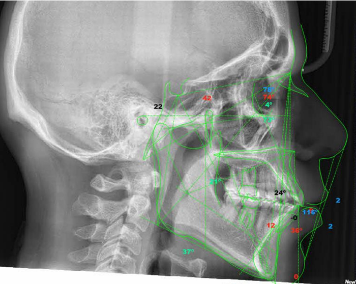 Cefalometria-Santiago-RD